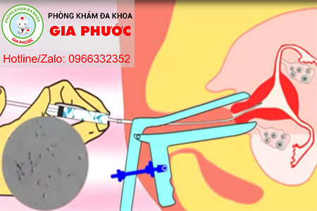 bom tinh trung vao trong buong tu cung