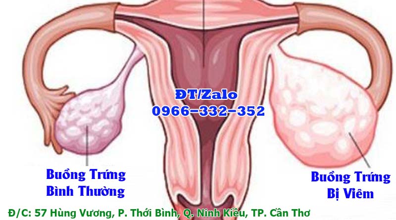 Nguyên Nhân Gây Viêm Buồng Trứng - Đa khoa Cần Thơ