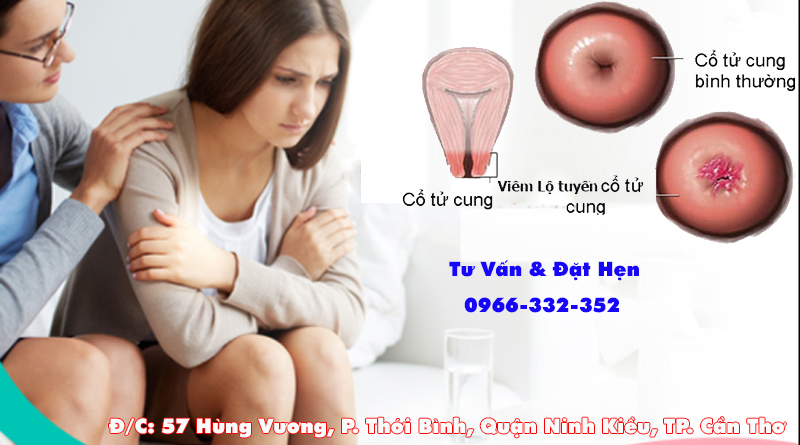 Viêm Lộ Tuyến Cổ Tử Cung - Triệu Chứng Và Cách Điều Trị