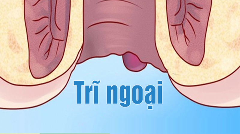 Cách chữa dứt điểm bệnh trĩ ngoại | Đa khoa Gia Phước