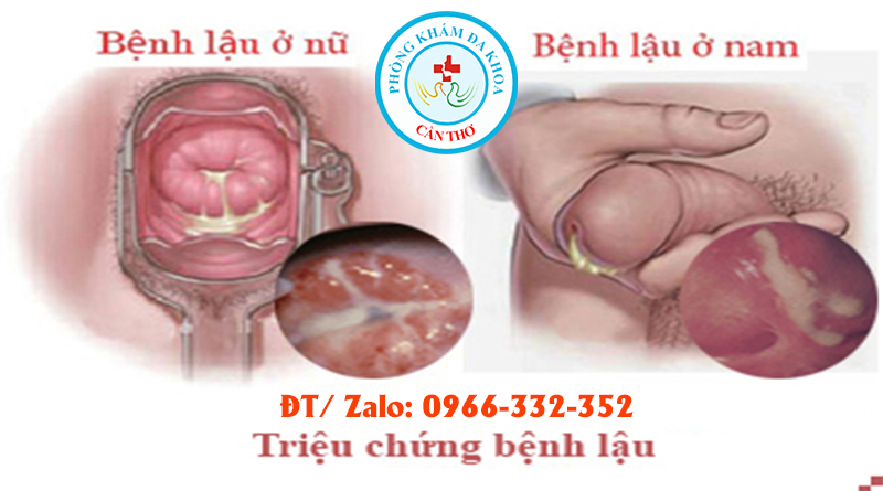 Bệnh lậu là gì? Nguyên nhân gây ra và cách phòng tránh