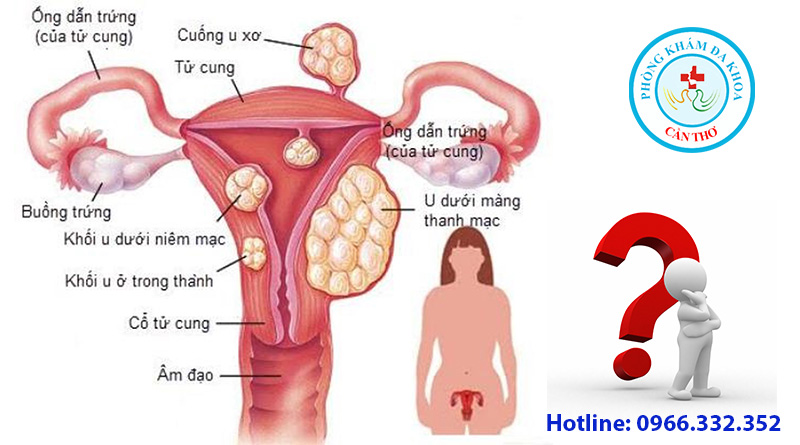 Bệnh u xơ tử cung là gì? Có di truyền không? | Đa khoa Cần Thơ