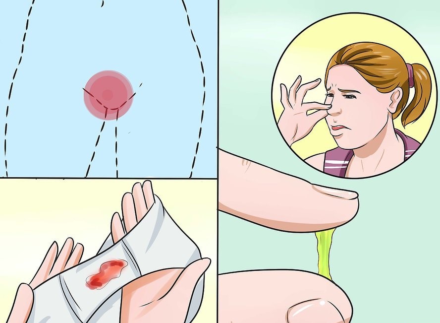 Nguyên nhân khí hư bất thường ở chị em phụ nữ là gì?