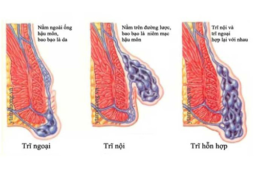 Những dấu hiệu nhận biết bệnh trĩ | Đa khoa Cần Thơ