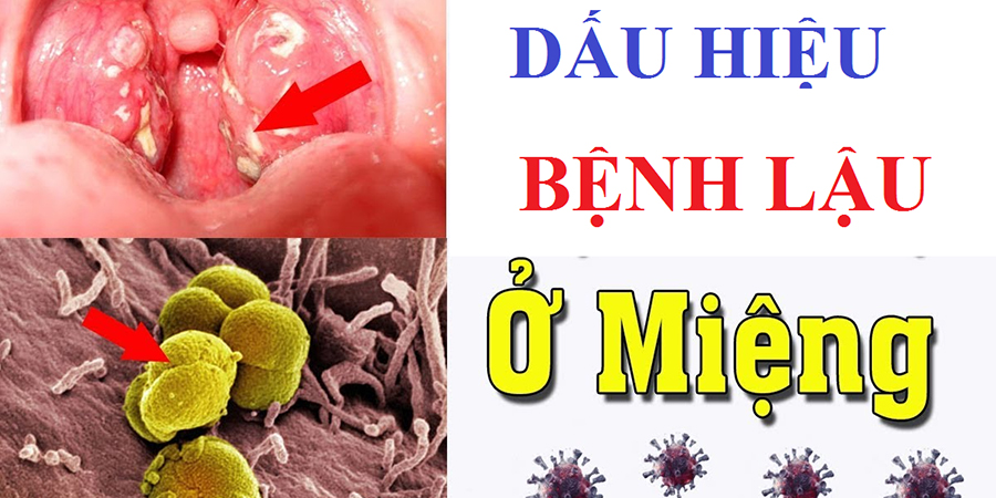 Bệnh lậu ở họng nguy hiểm thế nào? | Đa khoa Cần Thơ