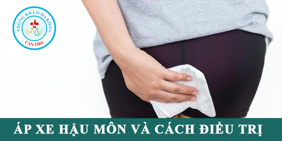 Áp xe hậu môn và cách điều trị | Đa khoa Cần Thơ
