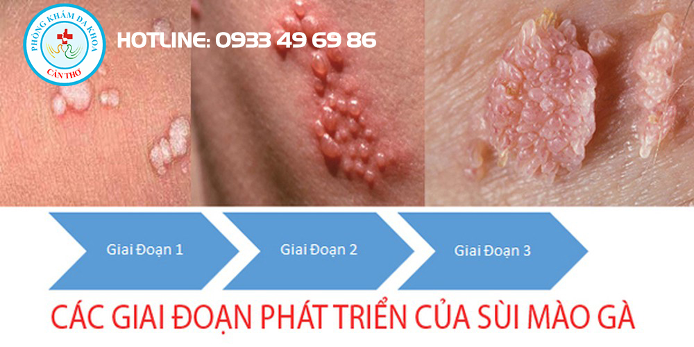 Đối tượng dễ mắc bệnh Sùi mào gà | Bệnh xã hội | Đa khoa Cần Thơ